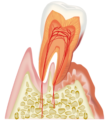 歯周病の歯
